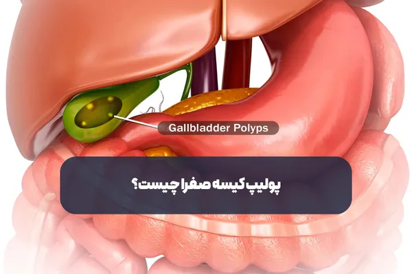 پولیپ کیسه صفرا