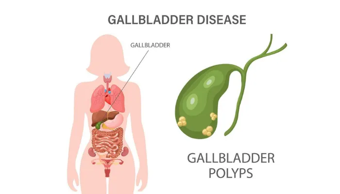 Types of gallbladder polyps
