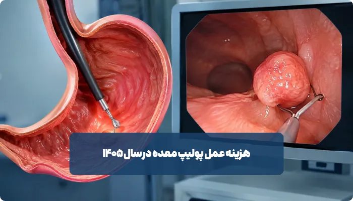 برداشتن پولیپ معده