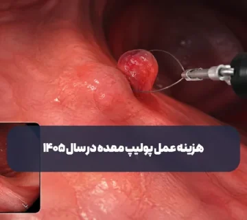هزینه عمل پولیپ معده در سال ۱۴۰۵