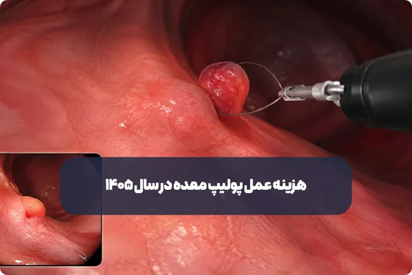 هزینه عمل پولیپ معده در سال ۱۴۰۵