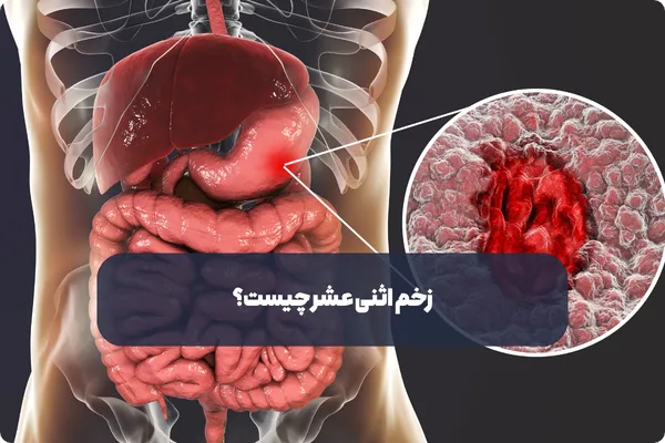 زخم اثنی عشر چیست