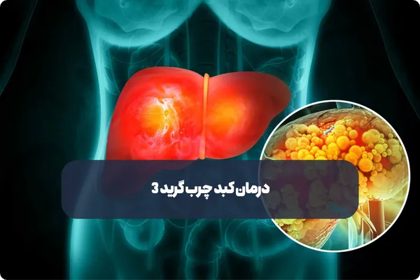 درمان کبد چرب گرید ۳